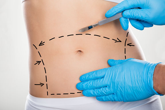 Abdominoplastik Havelland